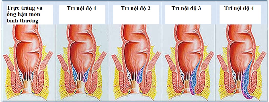  NHỮNG ĐIỀU CẦN BIẾT VỀ BỆNH TRĨ